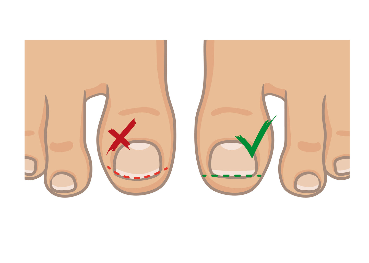 Feile für eingewachsene Zehennägel